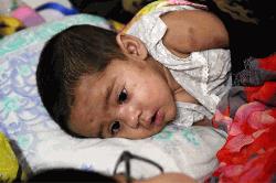 হাম ও হামের উপসর্গ নিয়ে আরও ৮ শিশুর মৃত্যু, ঢাকাতেই ৫